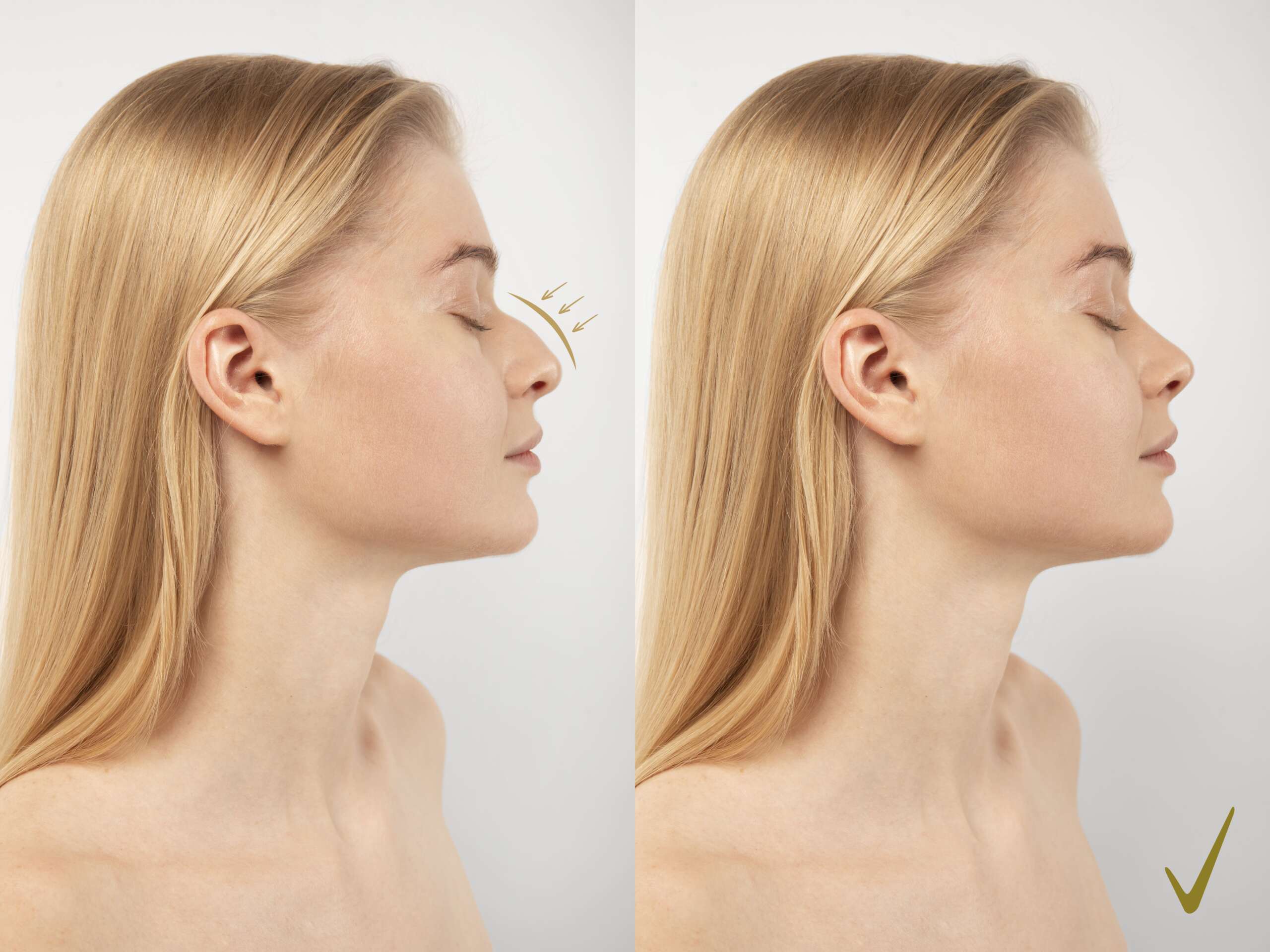 Nose Shape Correction